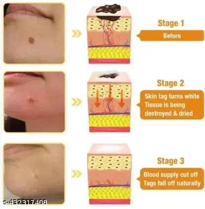 Pack of 2 - DERMA SMOOTH® SKIN TAG REMOVER PATCH – 288 Patches