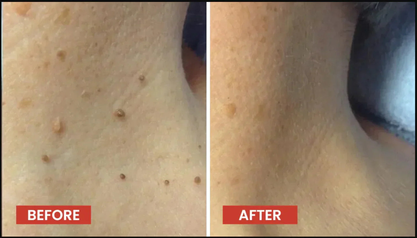 Pack of 2 - DERMA SMOOTH® SKIN TAG REMOVER PATCH – 288 Patches